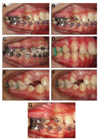 Influence of Low-Level Laser on Orthodontic Movement and Pain Control in Humans